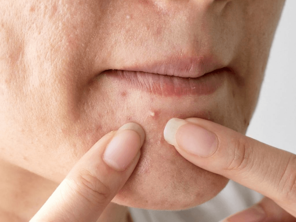 Cách trị mụn đơn giản không cần mỹ phẩm đắt tiền mà da vẫn láng mịn