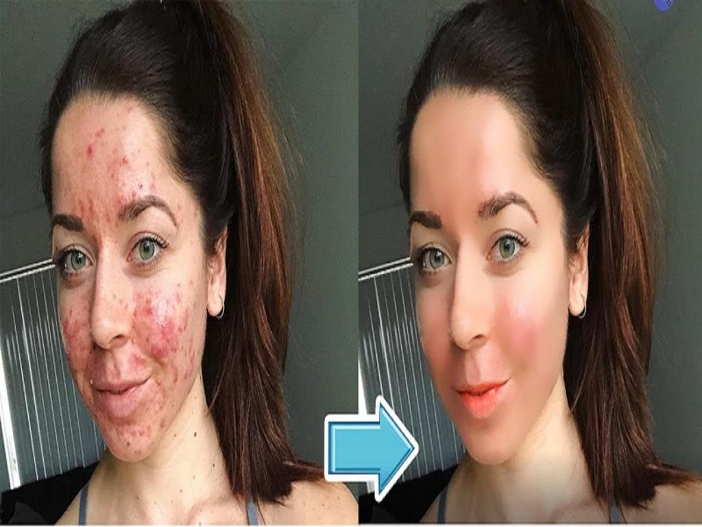 Tiêu chí chọn ứng dụng xóa mụn phù hợp