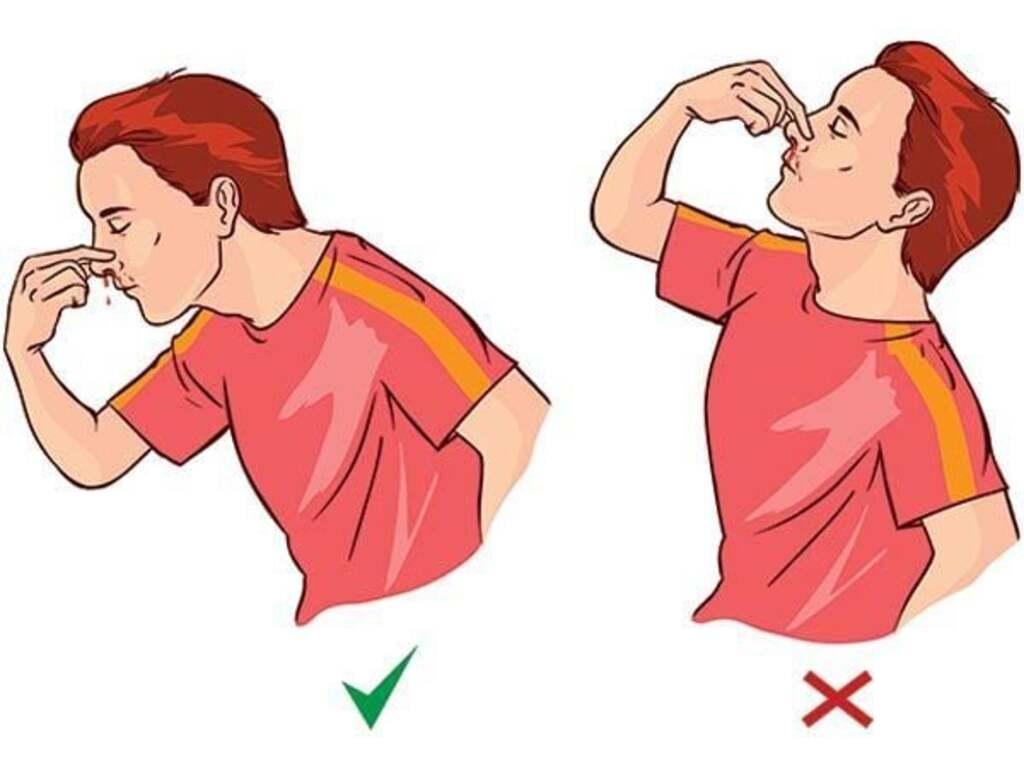 Cách điều trị chảy máu cam tại nhà