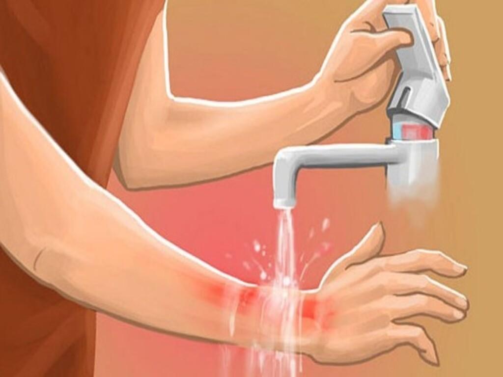 Bị ớt dính vào da phải làm sao để giảm rát nhanh chóng