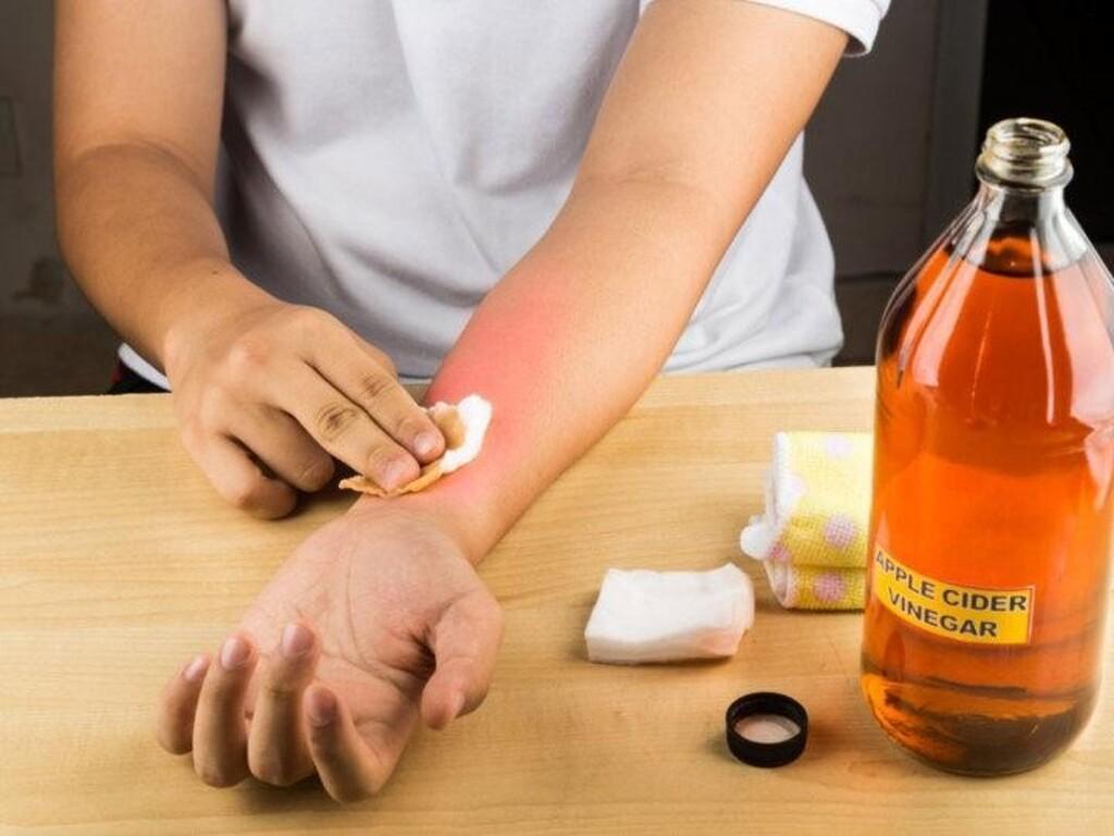 Các loại thuốc trị bỏng ớt và lưu ý khi sử dụng