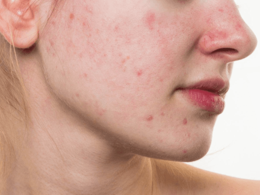 vi-sao-mua-he-la-ac-mong-cho-lan-da