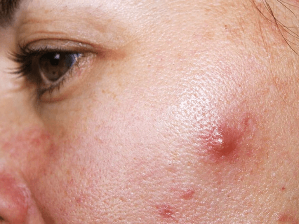 vi-sao-ban-khong-can-my-pham-dat-tien-van-tri-mun-hieu-qua