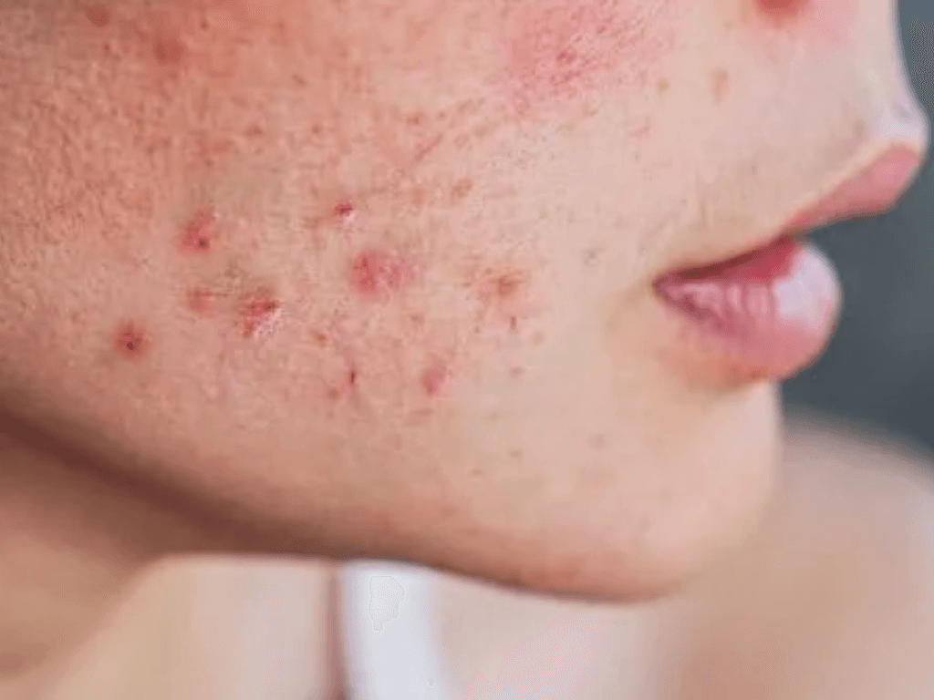 cach-tri-mun-don-gian-tu-nguyen-lieu-thien-nhien-khong-ton-kem