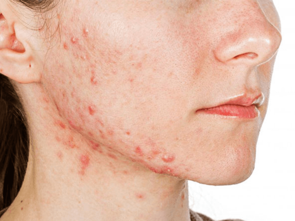 khi-nao-nen-den-gap-bac-si-da-lieu-du-da-thu-cach-tri-mun-don-gian