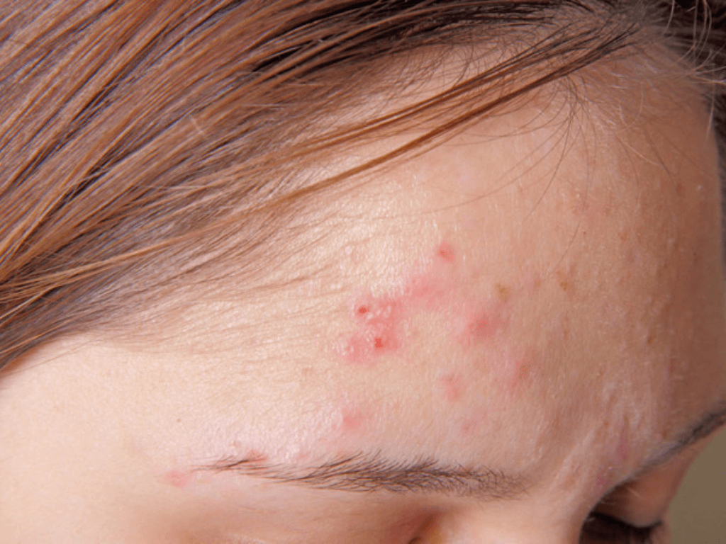 nhung-loai-mun-thuong-gap-khi-thuc-khuya-keo-dai