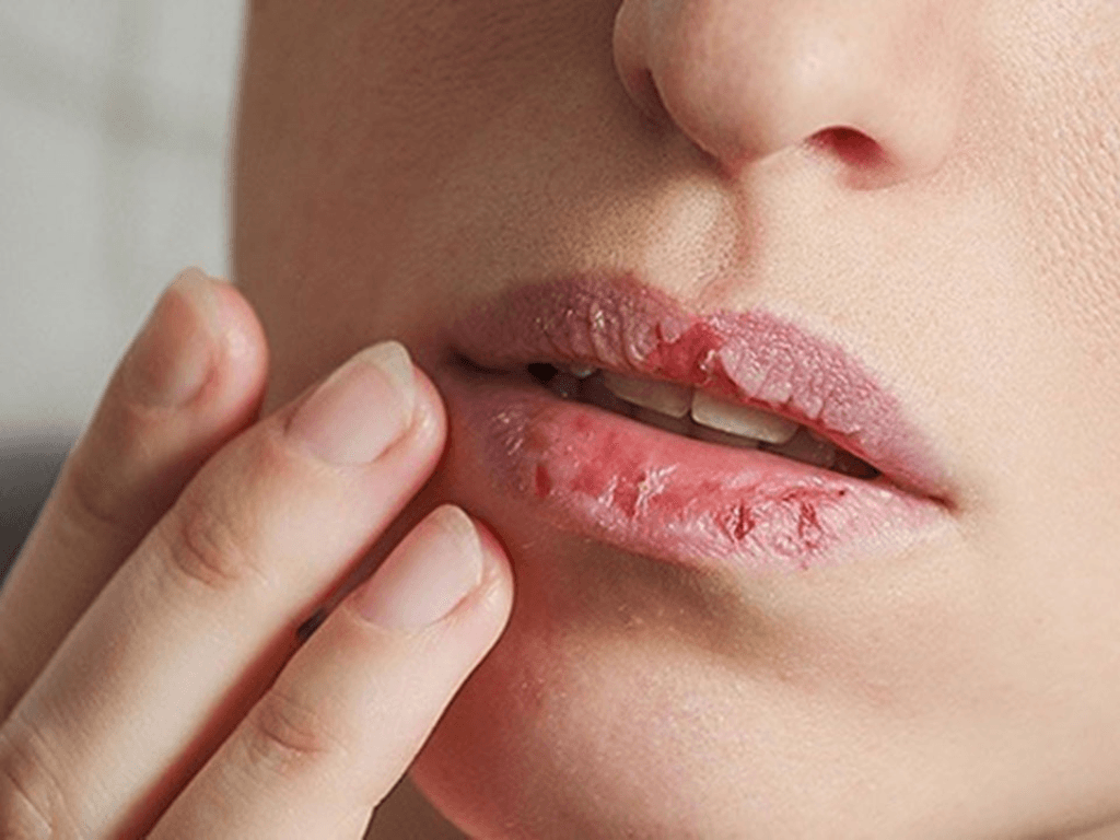 nguyen-nhan-khien-moi-bi-kho-nut-ne