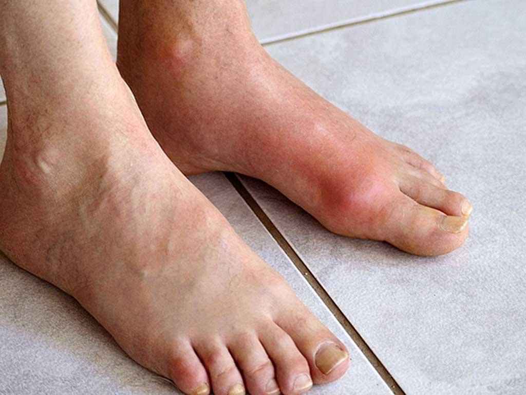 nguoi-bi-gout-tuyet-doi-khong-an-mang