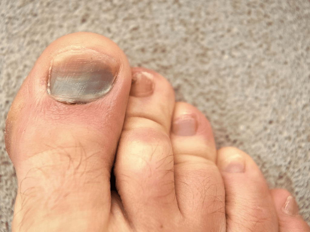 Cach-lam-tan-mau-bam-o-mong-chan-lau-ngay