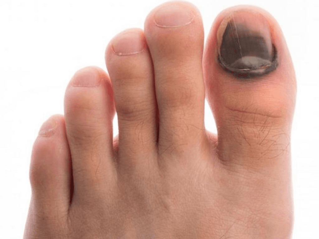 Dap-mong-tay-bao-lau-thi-khoi