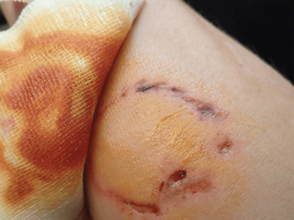 Vi-sao-sau-khi-chich-ngua-cho-can-can-kieng-an