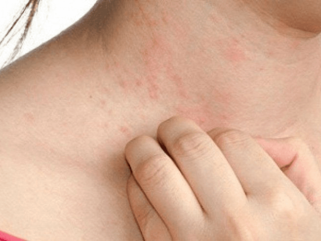 Vấn đề về da trong mùa hè giải mã “combo” đổ dầu cháy nắng bít lỗ chân lông