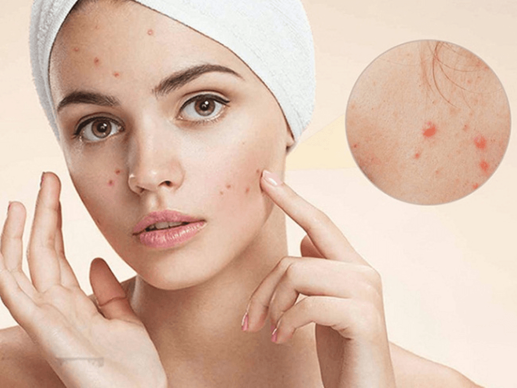 Có nên dùng máy massage cho da mụn để detox da hay đang tự “tra tấn” da mặt