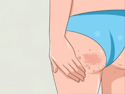 cách trị thâm mông cấp tốc