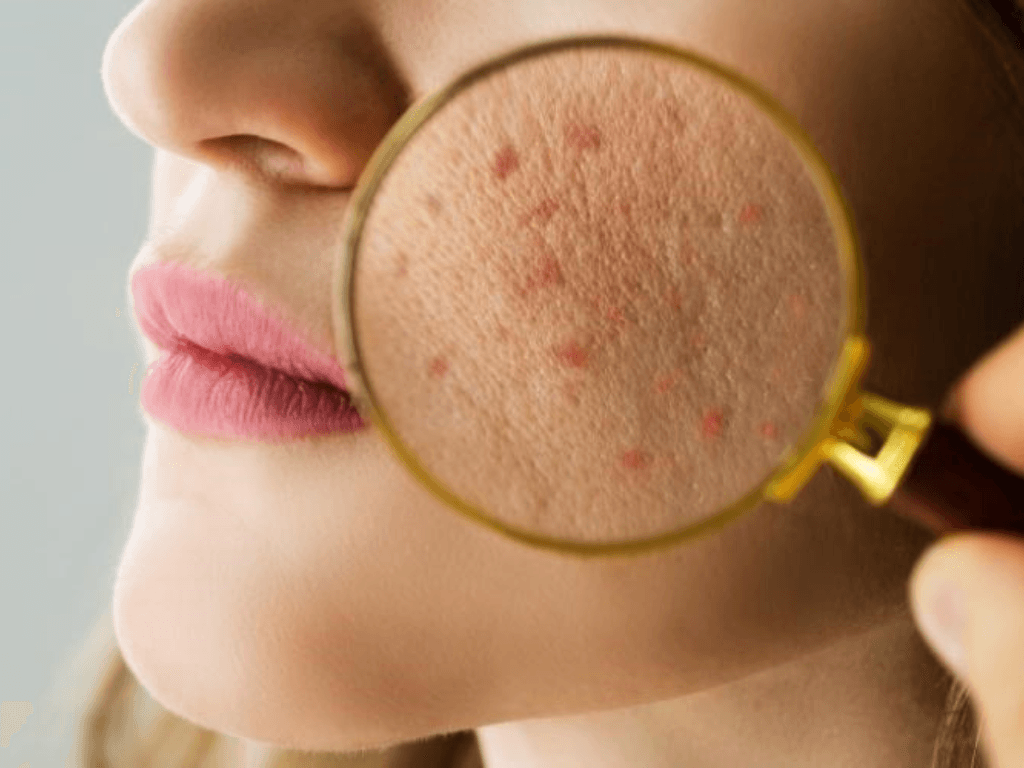 LHA có tác dụng gì trong mỹ phẩm? So sánh với BHA và AHA để tìm ra “chân ái”