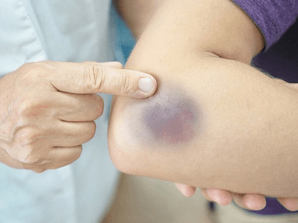 Cách làm tan vết bầm tím nhanh chỉ sau 1 đêm mẹo nhỏ từ chuyên gia sơ cứu