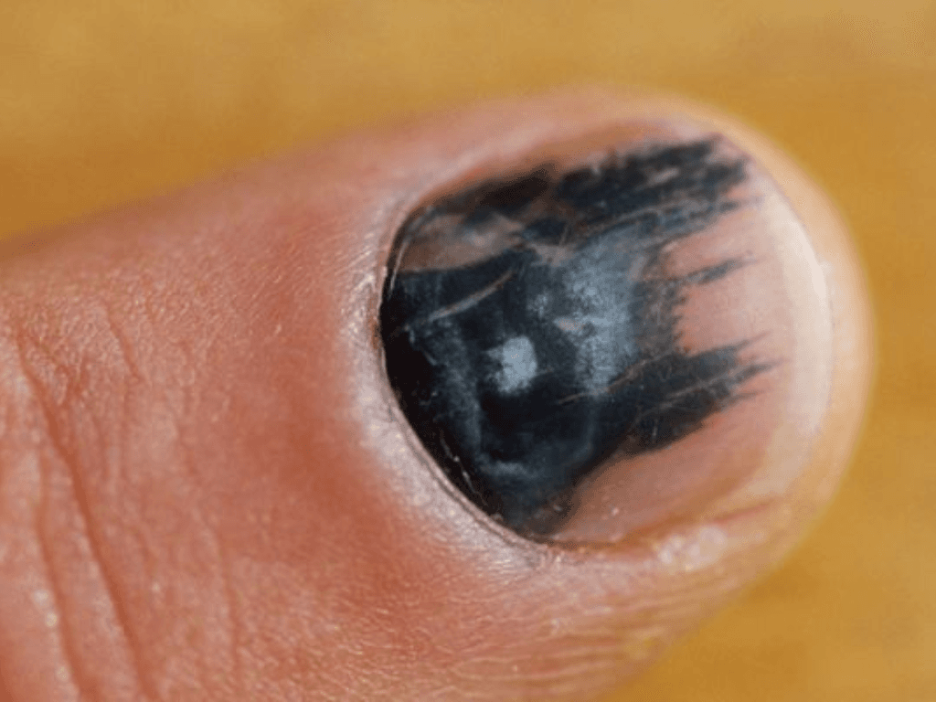 Cách làm tan máu bầm ở móng chân lâu ngày không cần bác sĩ - không tốn tiền