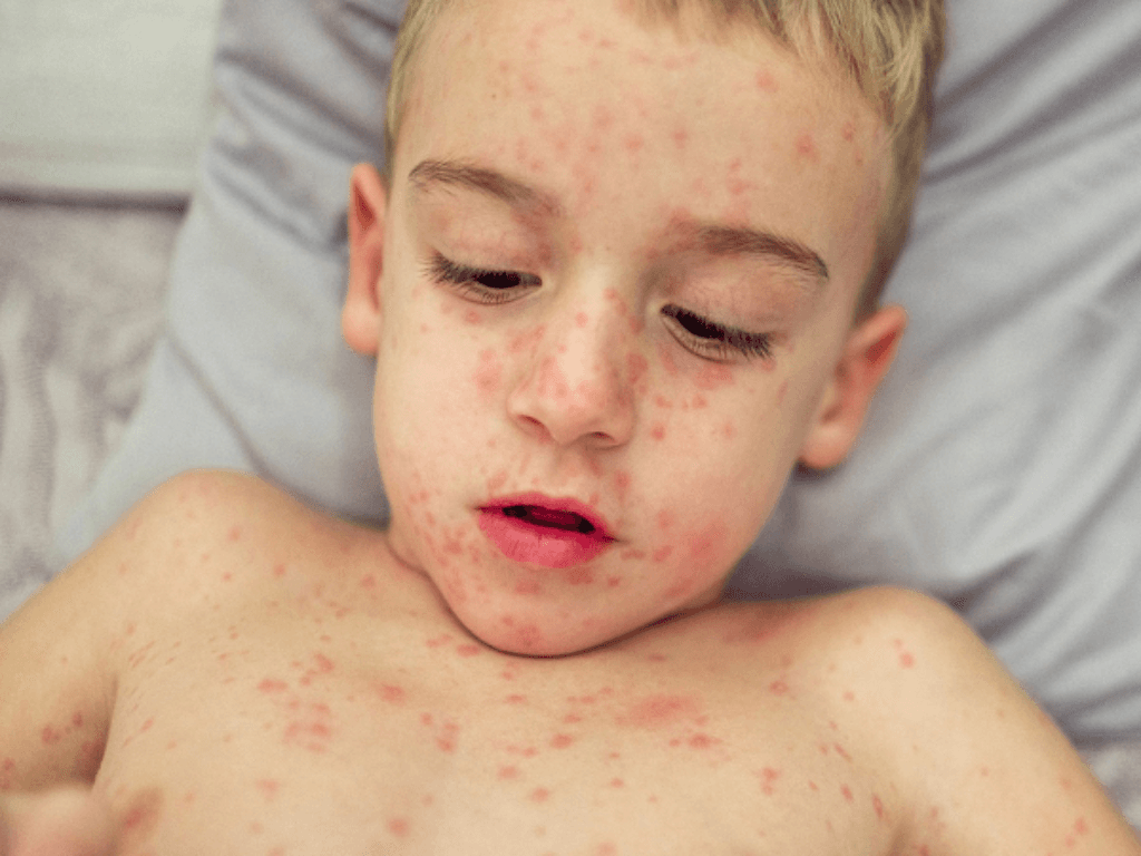 huong-dan-cham-soc-nguoi-bi-soi-dung-cach-tai-nha