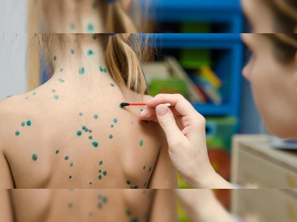 Bị thủy đậu có kiêng gió quạt không